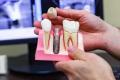 Имплантация зубов в СПБ недорого